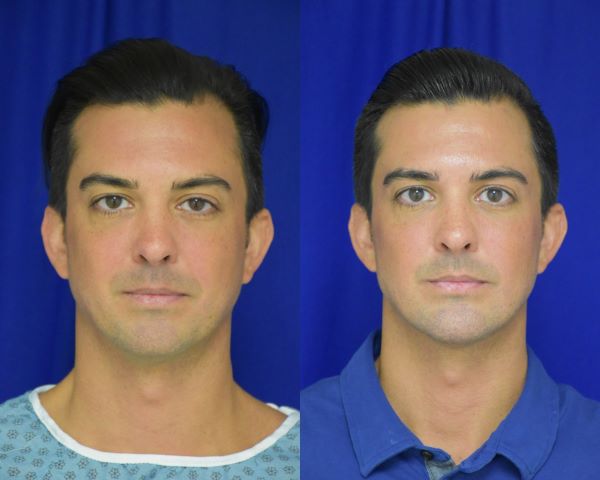 Chin Implant before and after photo by Dr. Sean Weiss in Metairie, LA