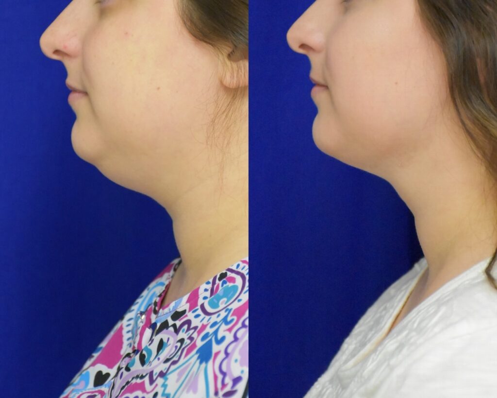 Liposuction before and after photo by Dr. Sean Weiss in Metairie, LA