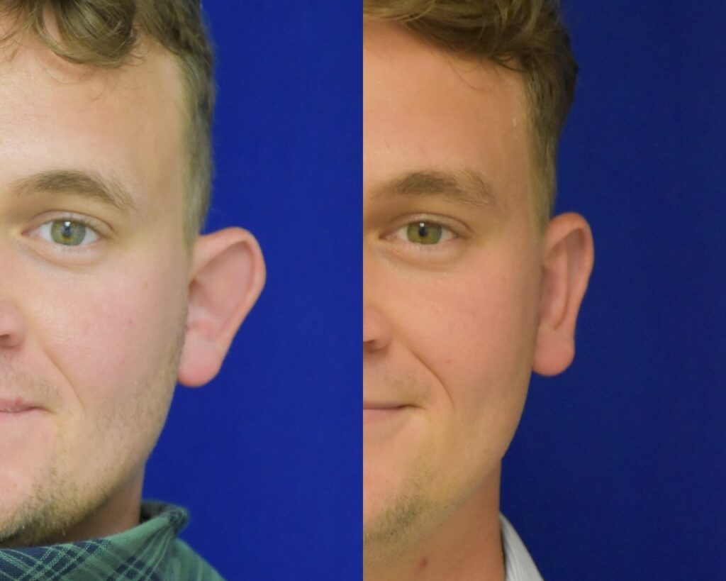 Otoplasty before and after photo by Dr. Sean Weiss in Metairie, LA