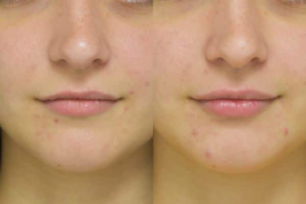 Injectable Filler before and after photo by Dr. Sean Weiss in Metairie, LA
