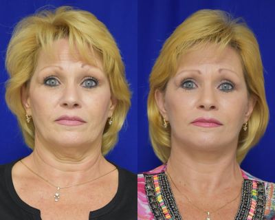 Facelift, Brow Lift before and after photo by Dr. Sean Weiss in Metairie, LA