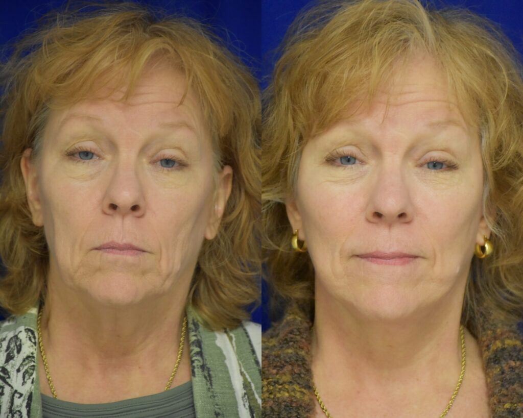 Facelift before and after photo by Dr. Sean Weiss in Metairie, LA
