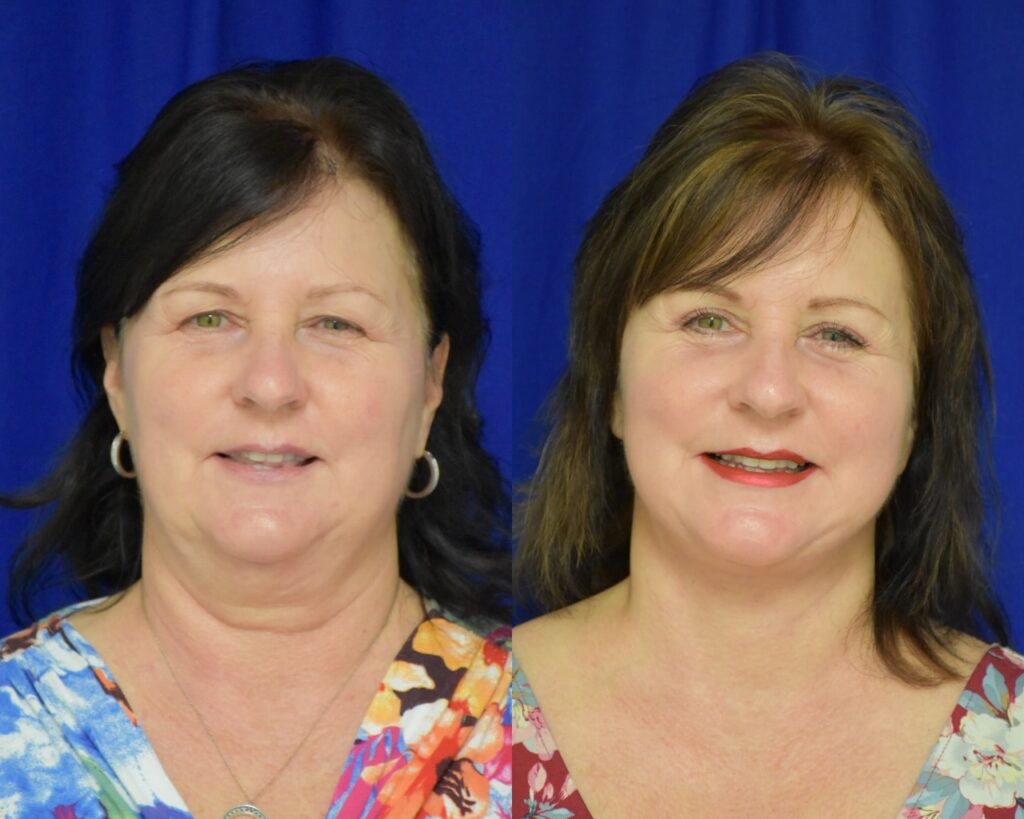 Facelift before and after photo by Dr. Sean Weiss in Metairie, LA