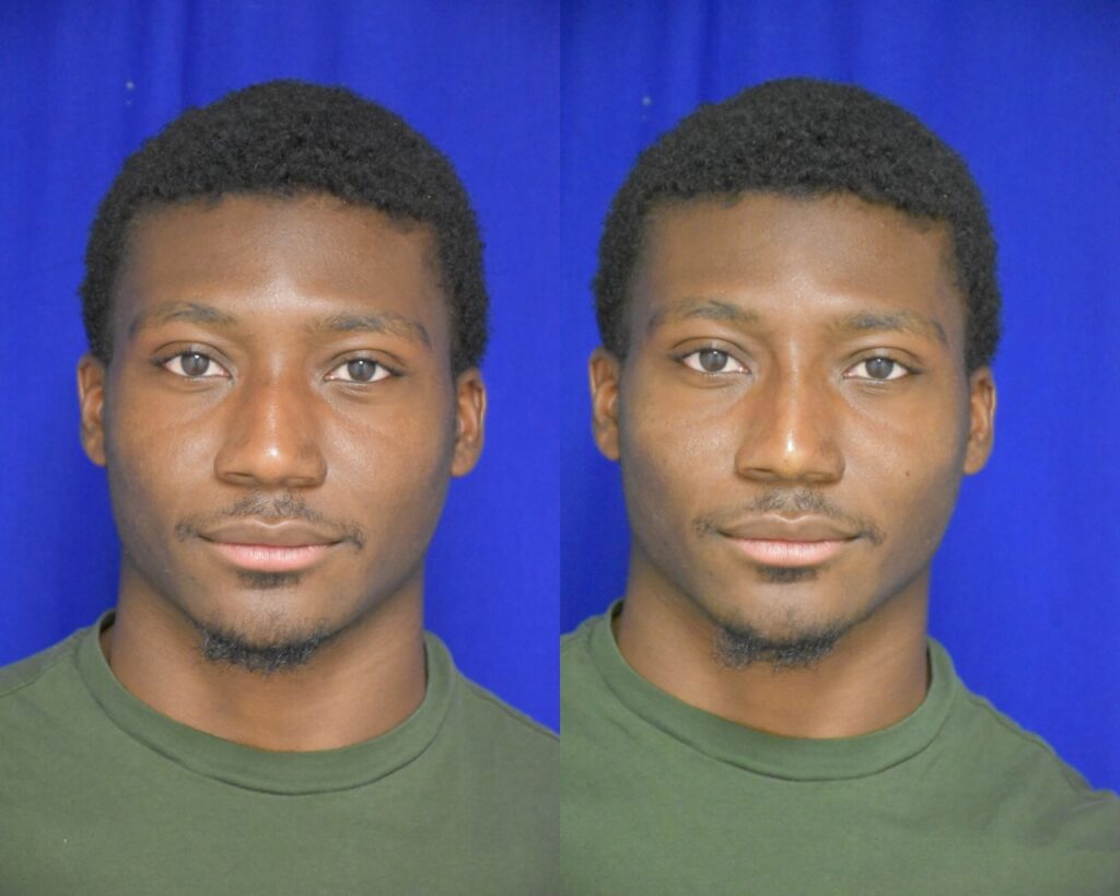 Liquid Rhinoplasty before and after photo by Dr. Sean Weiss in Metairie, LA
