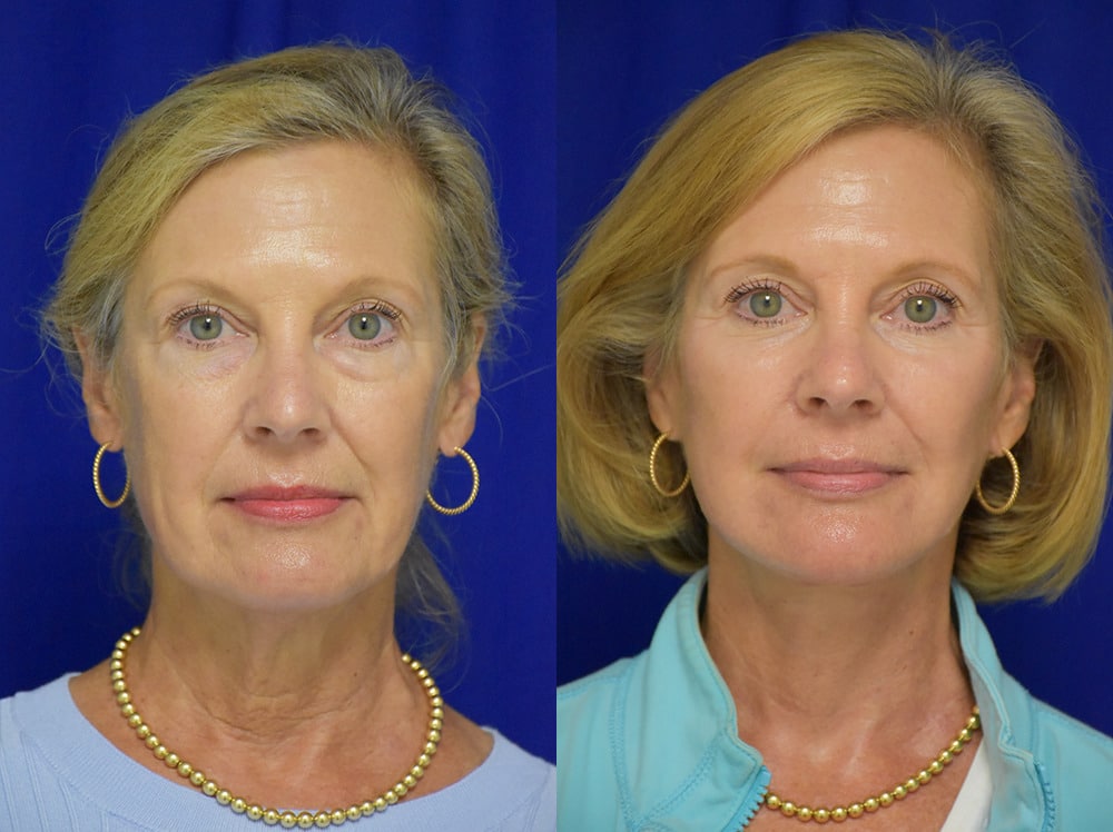 Facelift before and after photo by Dr. Sean Weiss in Metairie LA