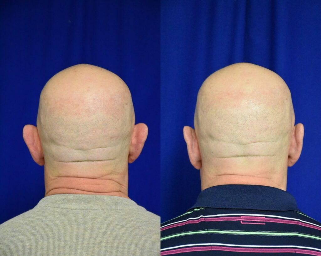 Otoplasty before and after photo by Dr. Sean Weiss in Metairie, LA