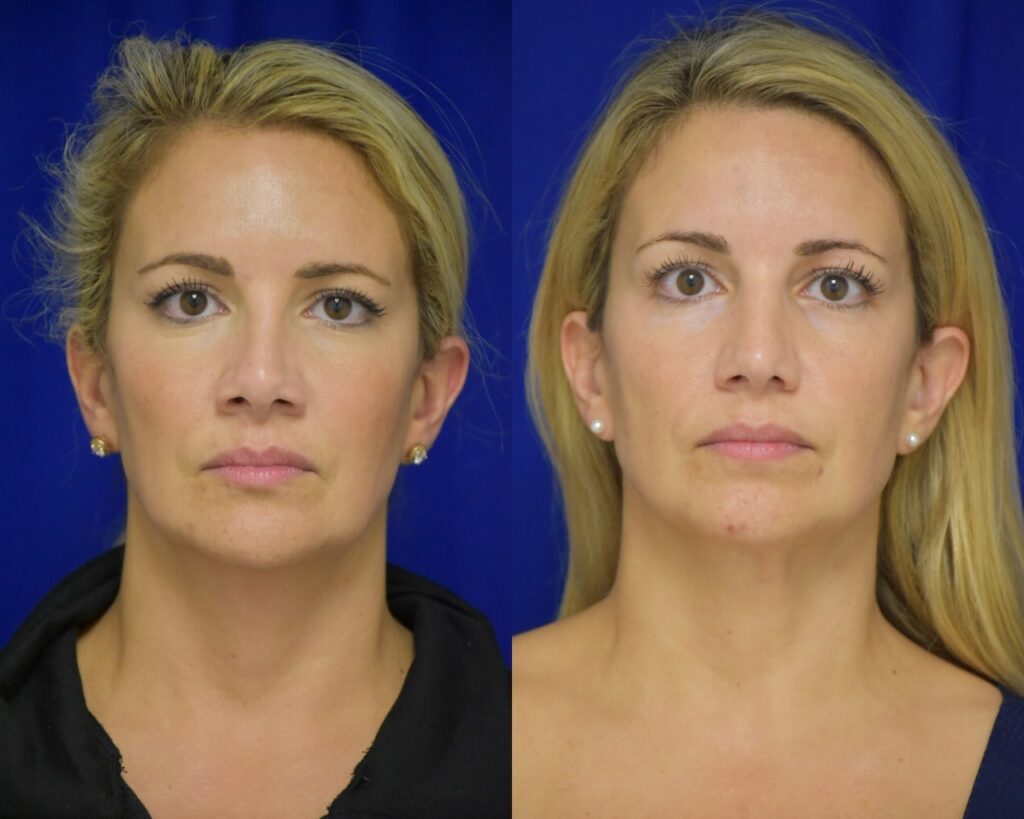 Rhinoplasty before and after photo by Dr. Sean Weiss in Metairie, LA