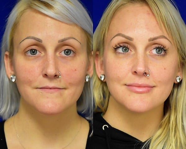Injectable Filler before and after photo by Dr. Sean Weiss in Metairie, LA