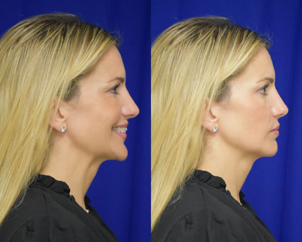 Rhinoplasty before and after photo by Dr. Sean Weiss in Metairie LA