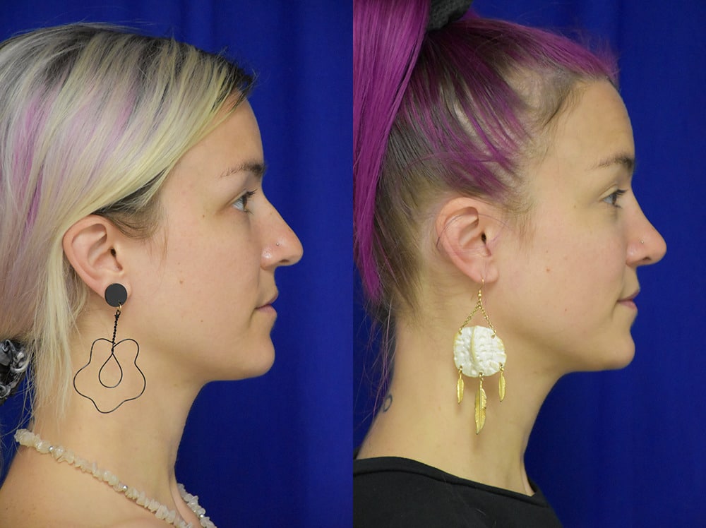 Rhinoplasty before and after photo by Dr. Sean Weiss in Metairie LA