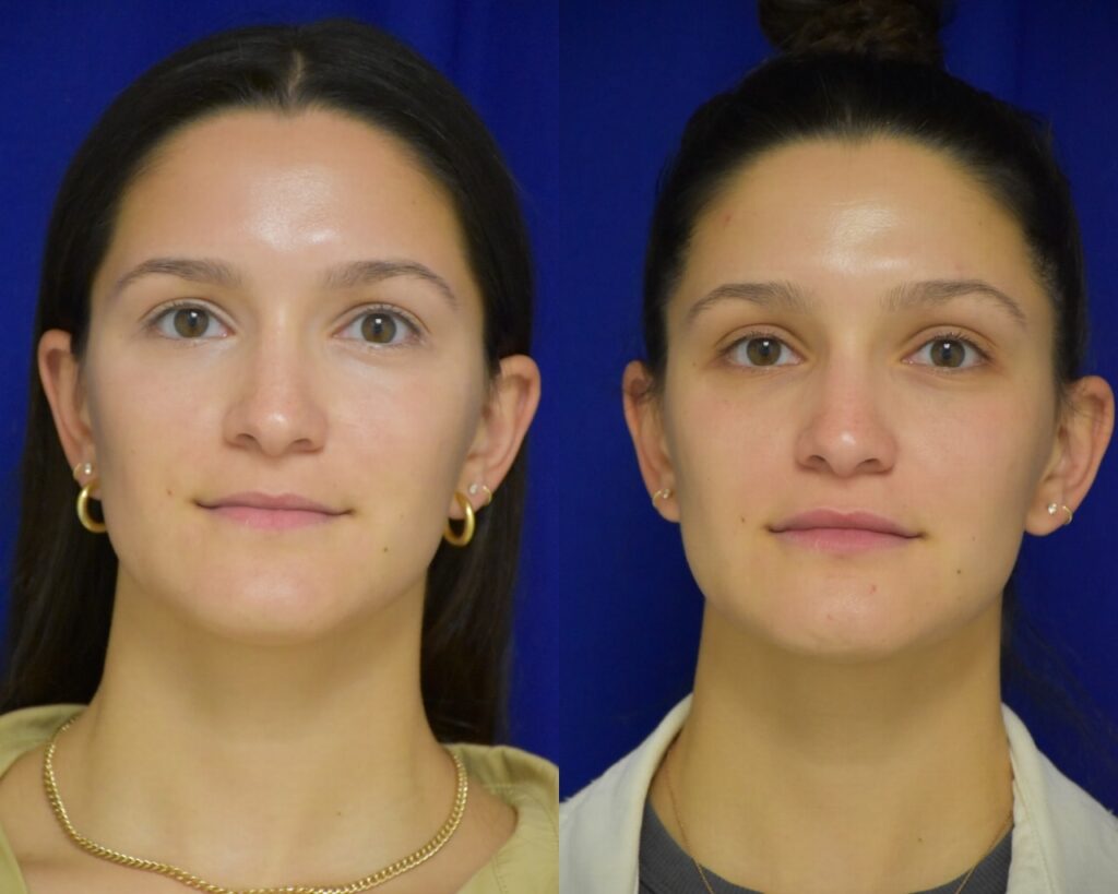 Injectable Filler before and after photo by Dr. Sean Weiss in Metairie, LA