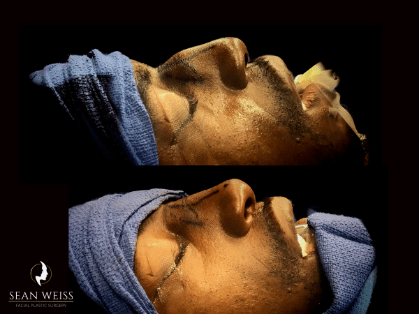 Rhinoplasty before and after photo by Dr. Sean Weiss in Metairie, LA