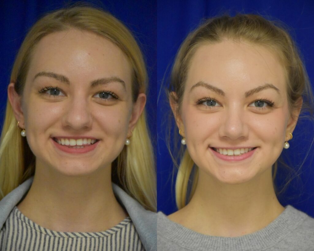 Rhinoplasty before and after photo by Dr. Sean Weiss in Metairie, LA
