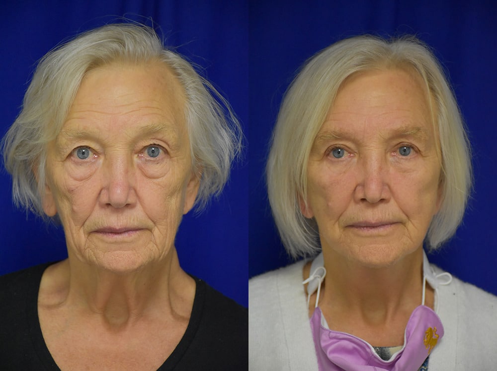 Facelift before and after photo by Dr. Sean Weiss in Metairie LA