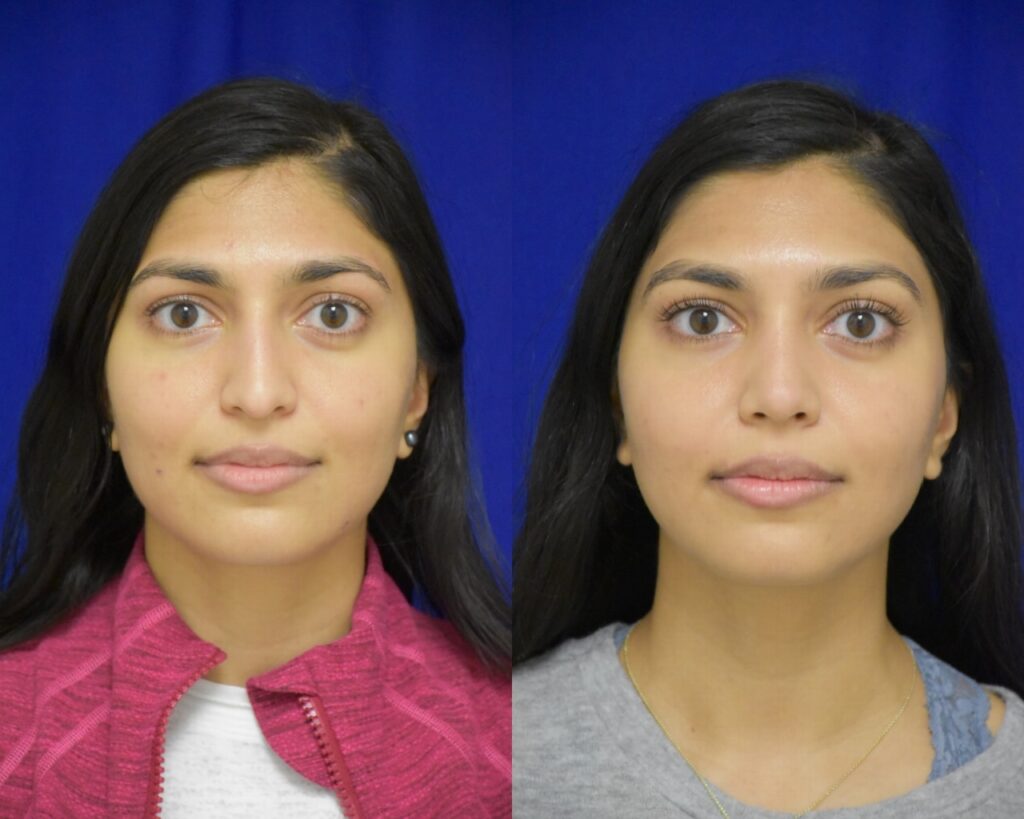 Rhinoplasty before and after photo by Dr. Sean Weiss in Metairie, LA