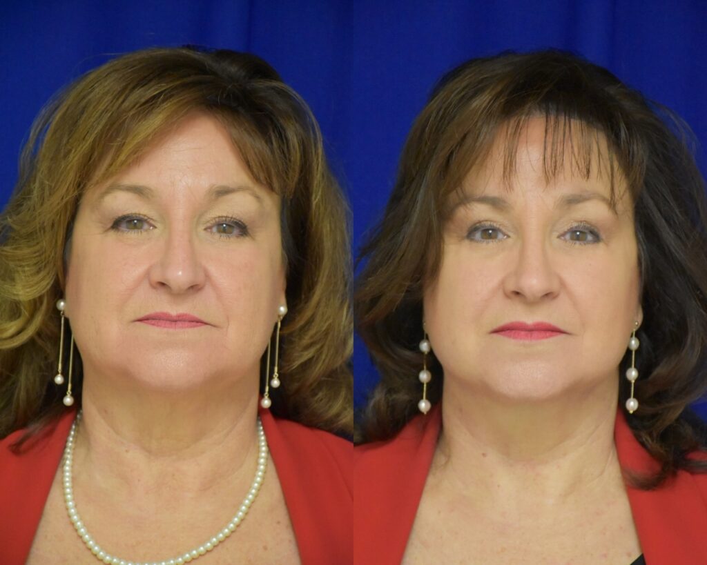 Facelift, Blepharoplasty before and after photo by Dr. Sean Weiss in Metairie, LA
