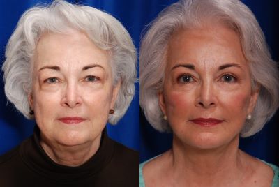 Facelift, Blepharoplasty, Liposuction before and after photo by Dr. Sean Weiss in Metairie, LA