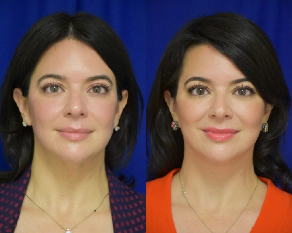 Facelift, Liposuction before and after photo by Dr. Sean Weiss in Metairie, LA