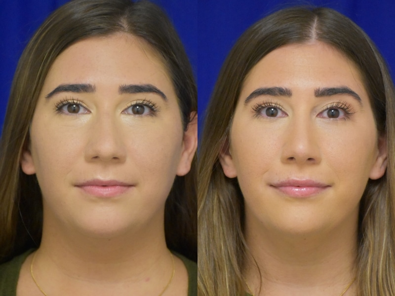 Rhinoplasty before and after photo by Dr. Sean Weiss in Metairie, LA