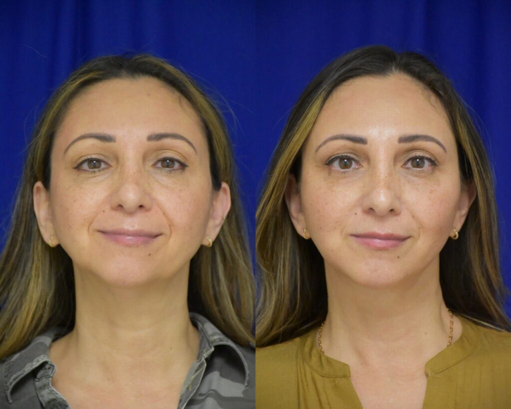 Facelift, Chin Implant before and after photo by Dr. Sean Weiss in Metairie, LA