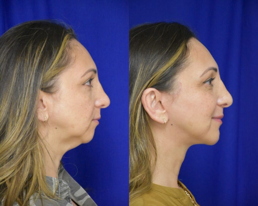 Facelift, Chin Implant before and after photo by Dr. Sean Weiss in Metairie, LA