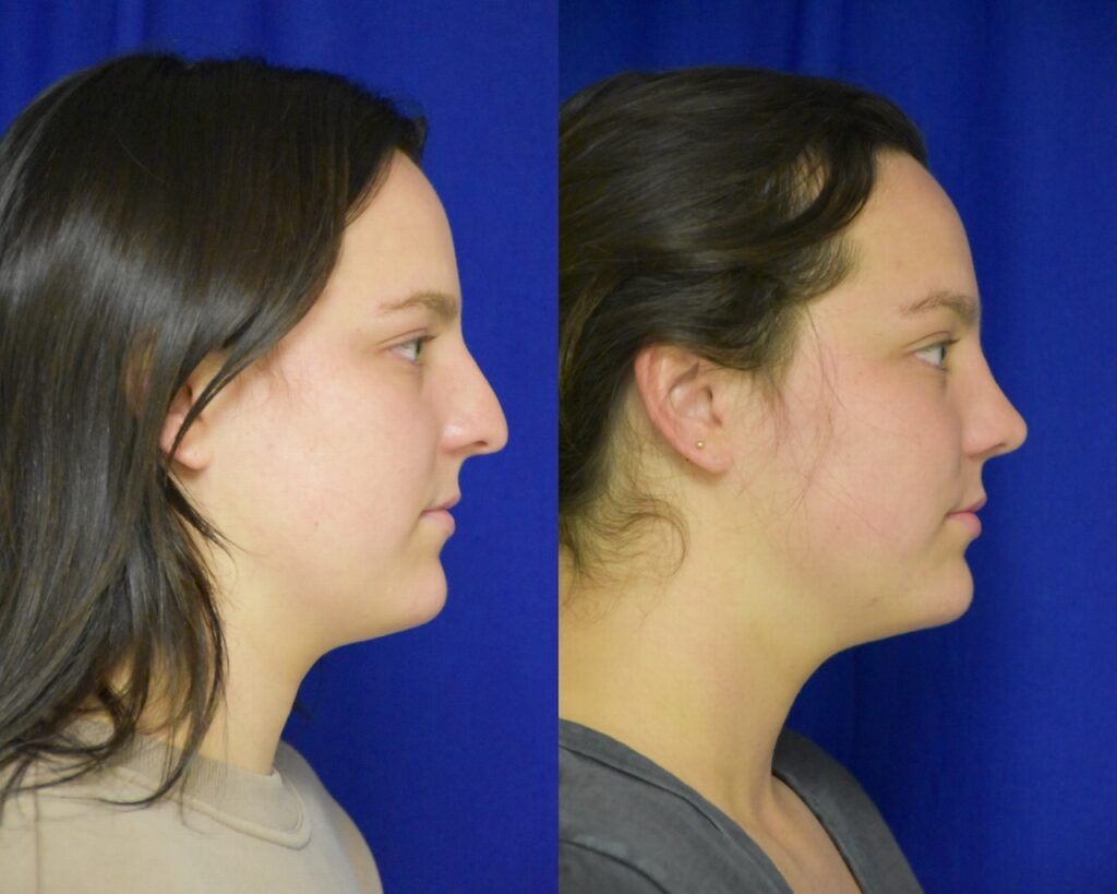 Rhinoplasty before and after photo by Dr. Sean Weiss in Metairie, LA