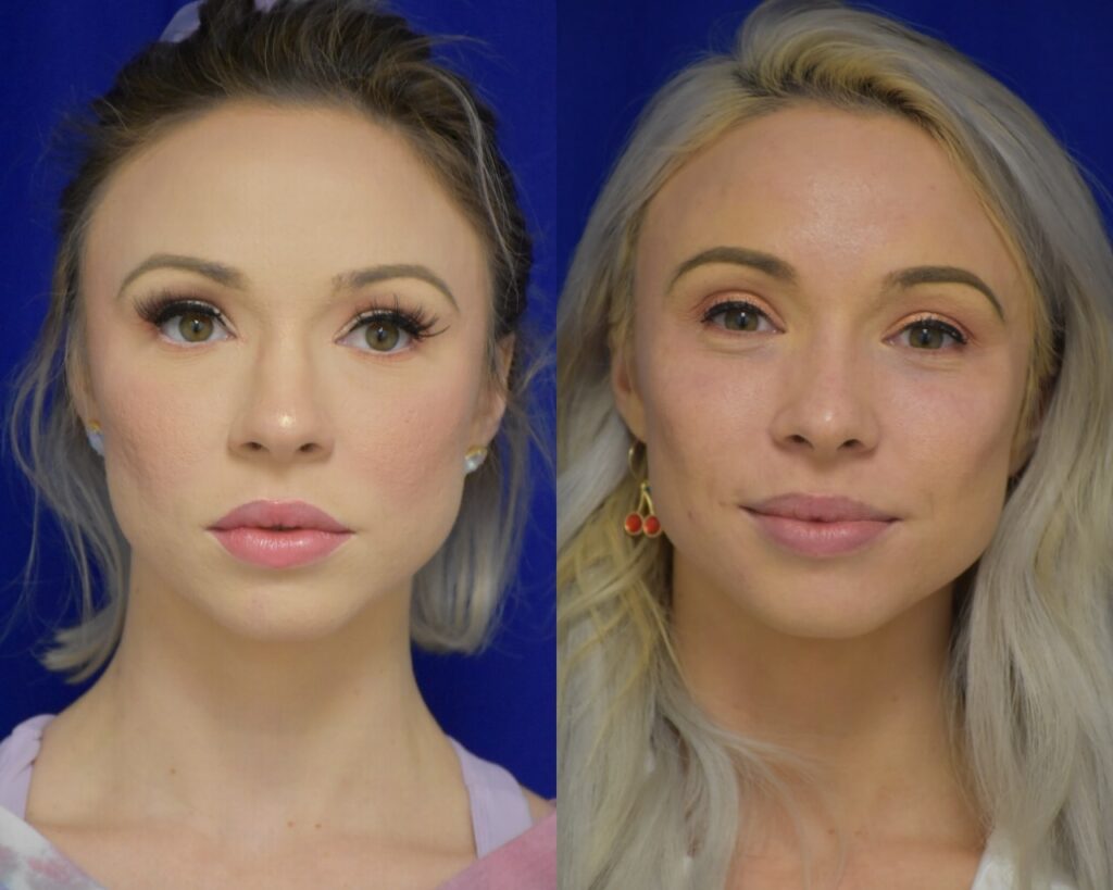 Rhinoplasty before and after photo by Dr. Sean Weiss in Metairie, LA