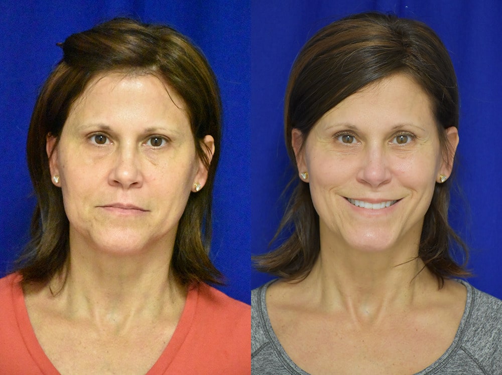 Blepharoplasty before and after photo by Dr. Sean Weiss in Metairie LA