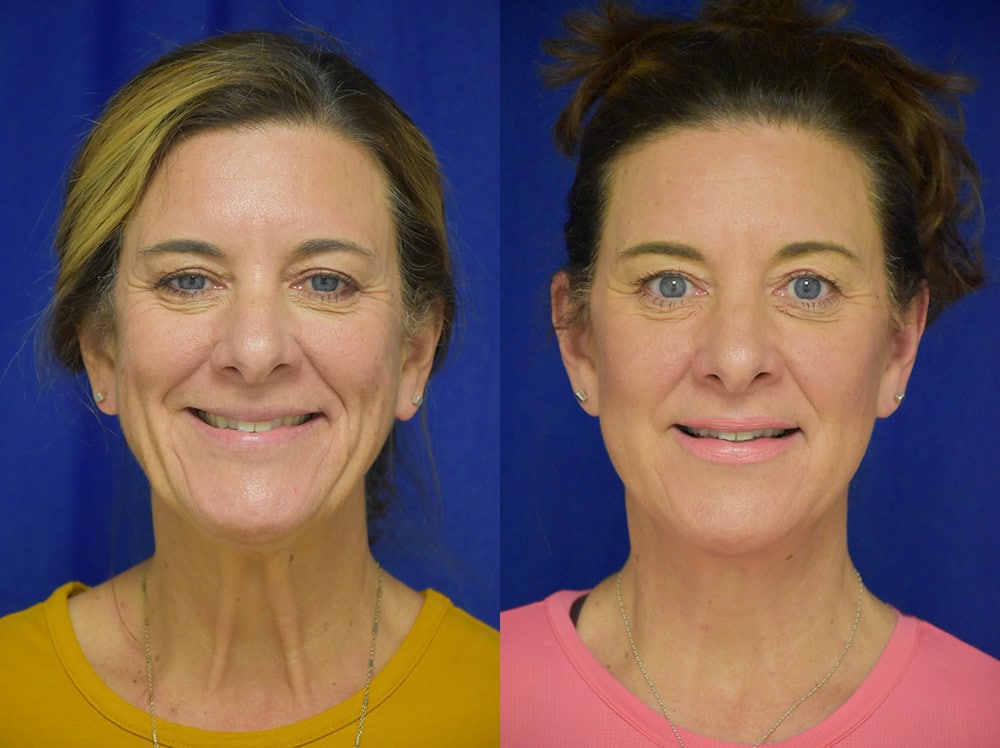 Facelift before and after photo by Dr. Sean Weiss in Metairie LA