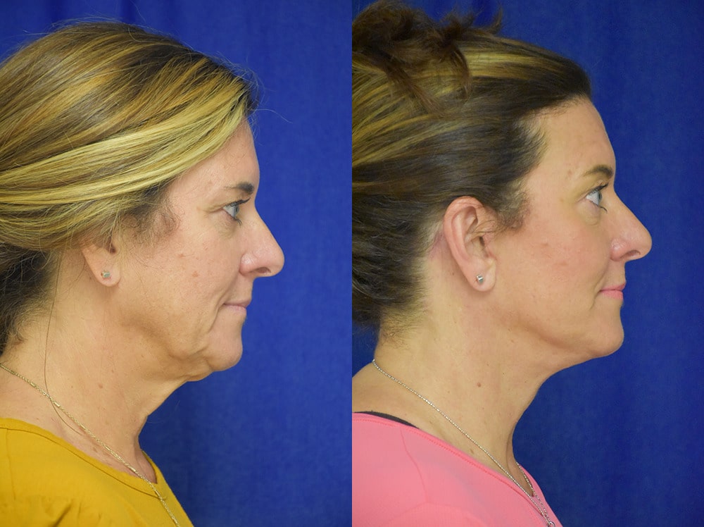 Facelift before and after photo by Dr. Sean Weiss in Metairie LA