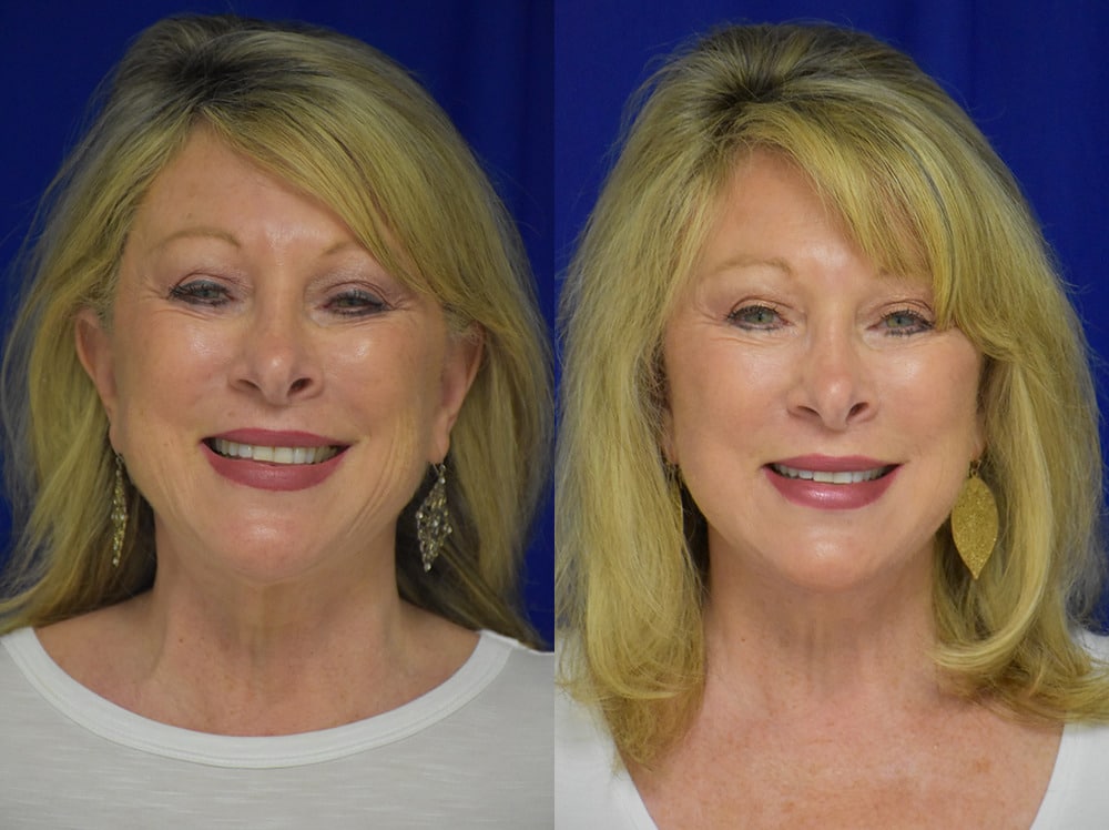 Facelift before and after photo by Dr. Sean Weiss in Metairie LA