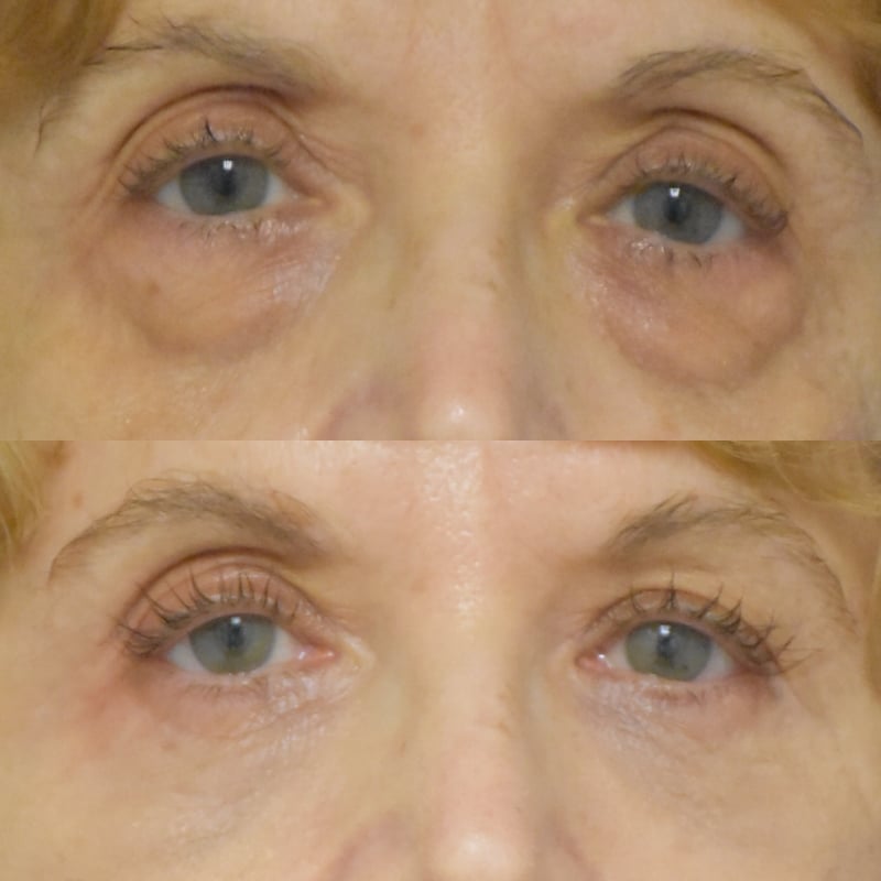 Facelift with Platysmaplasty, Lower Bleph before and after photo by Dr. Sean Weiss in Metairie LA