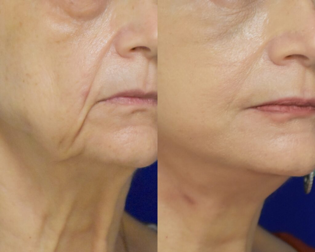 Facelift with Platysmaplasty, Lower Bleph before and after photo by Dr. Sean Weiss in Metairie LA