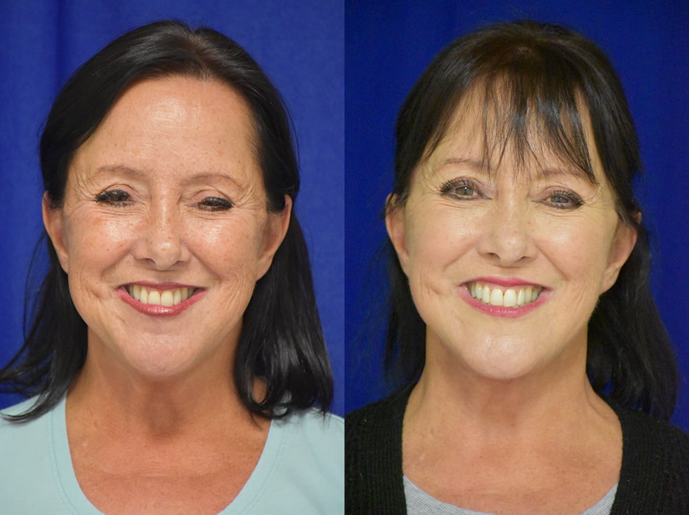 Facelift before and after photo by Dr. Sean Weiss in Metairie LA