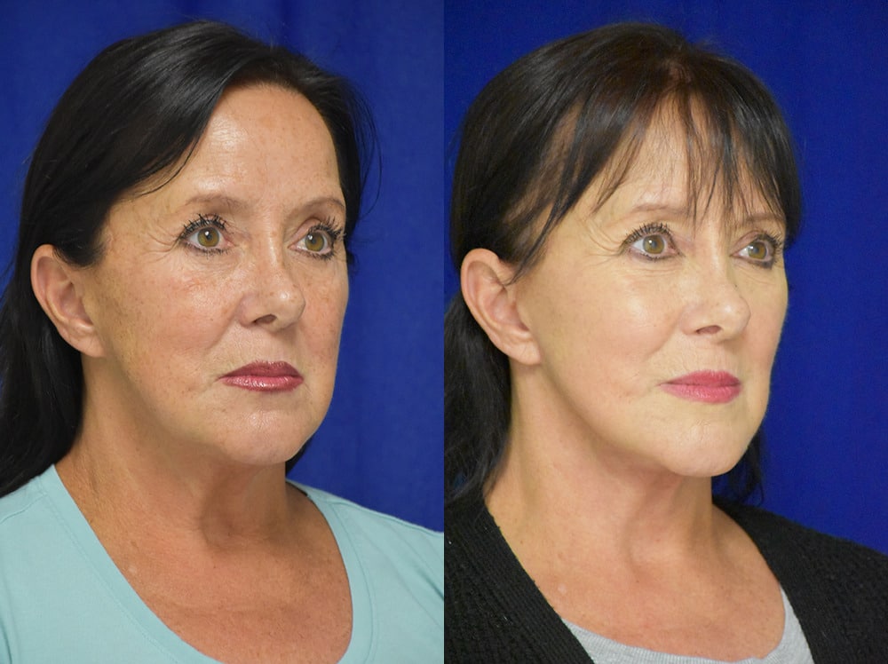 Facelift before and after photo by Dr. Sean Weiss in Metairie LA
