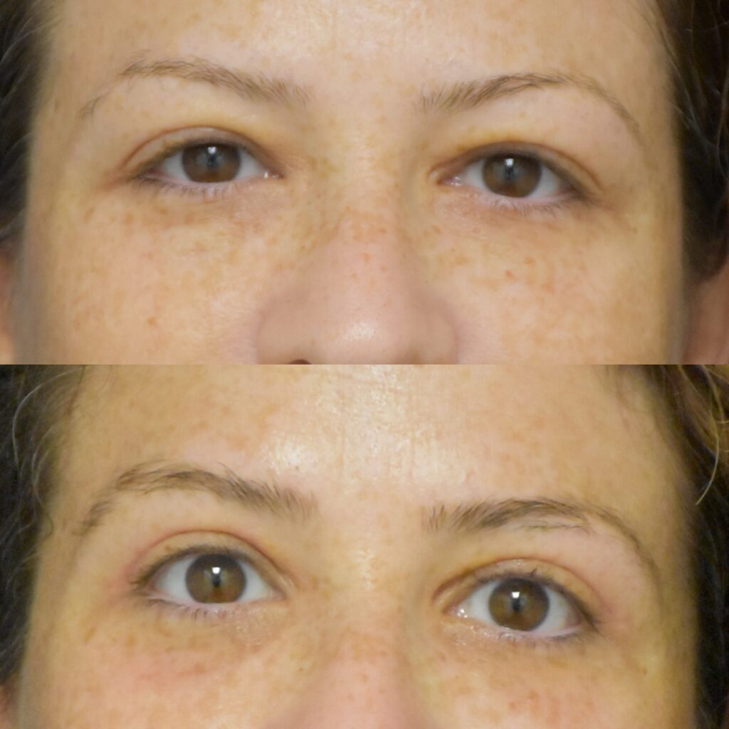 Blepharoplasty before and after photo by Dr. Sean Weiss in Metairie LA