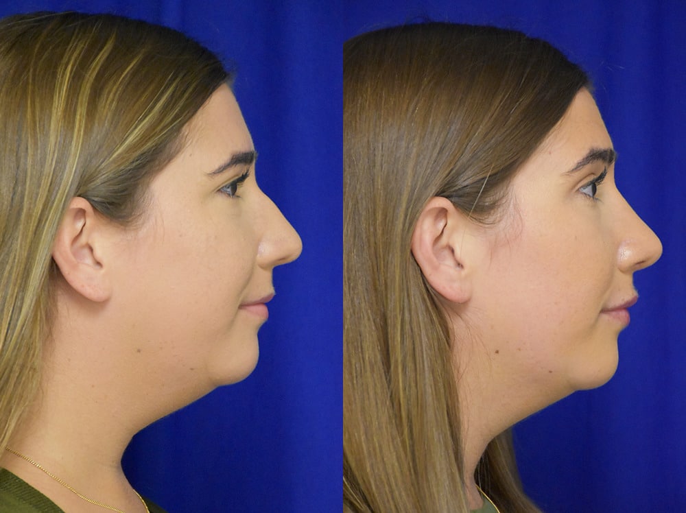 Rhinoplasty before and after photo by Dr. Sean Weiss in Metairie LA