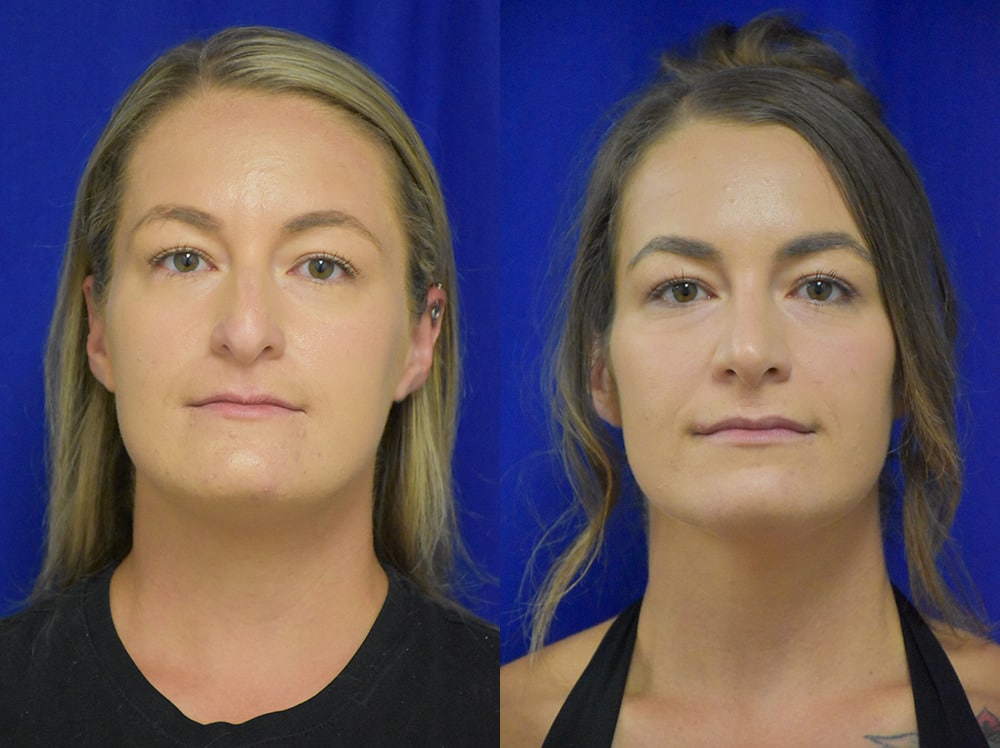 Rhinoplasty before and after photo by Dr. Sean Weiss in Metairie LA