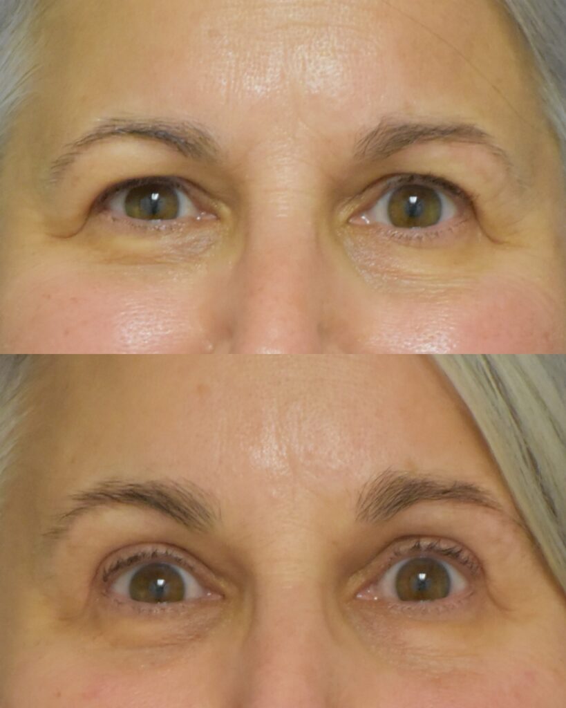 Blepharoplasty before and after photo by Dr. Sean Weiss in Metairie LA