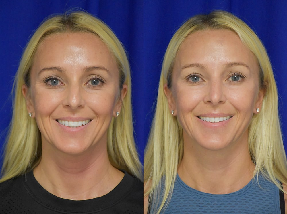 Rhinoplasty before and after photo by Dr. Sean Weiss in Metairie LA