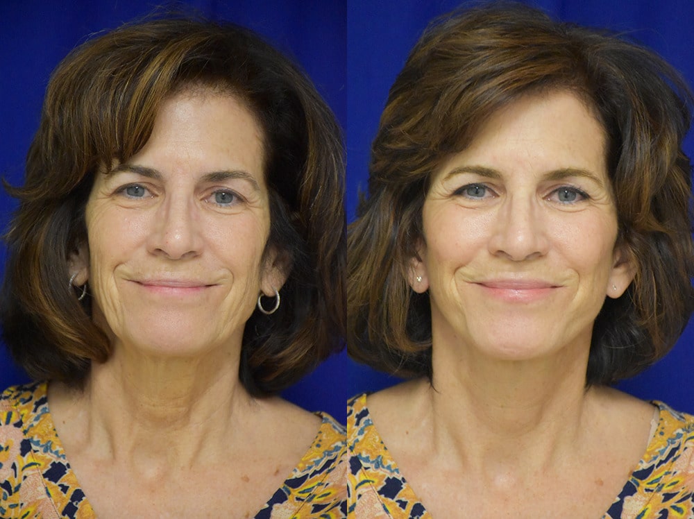 Facelift before and after photo by Dr. Sean Weiss in Metairie LA
