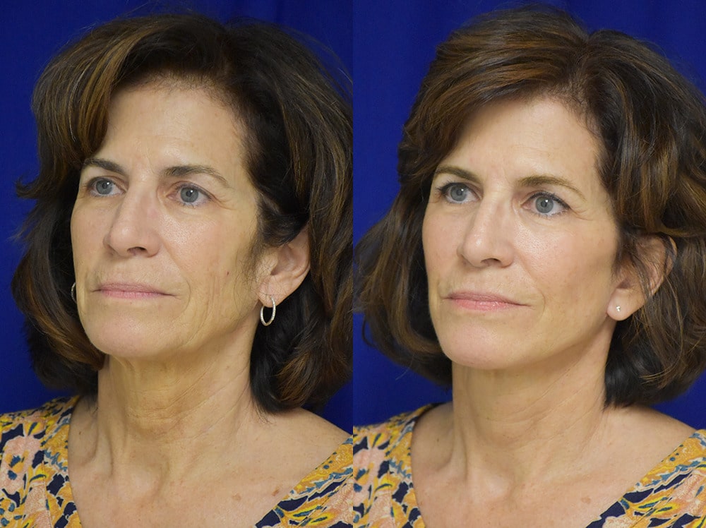 Facelift before and after photo by Dr. Sean Weiss in Metairie LA