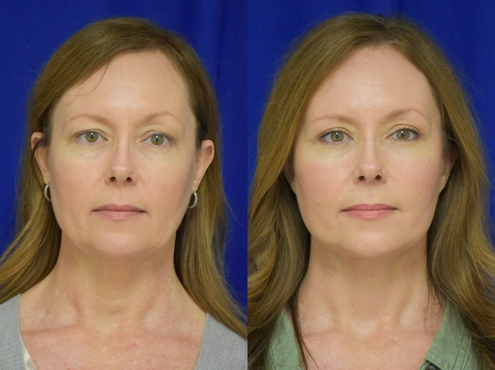 Blepharoplasty before and after photo by Dr. Sean Weiss in Metairie LA