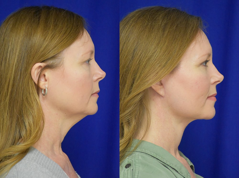 Blepharoplasty before and after photo by Dr. Sean Weiss in Metairie LA