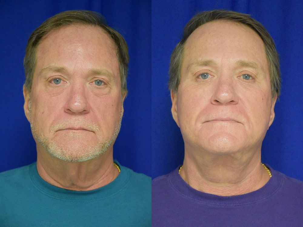 Fat Grafting before and after photo by Dr. Sean Weiss in Metairie LA