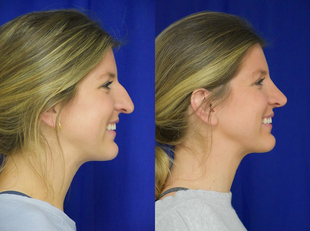 Rhinoplasty before and after photo by Dr. Sean Weiss in Metairie LA