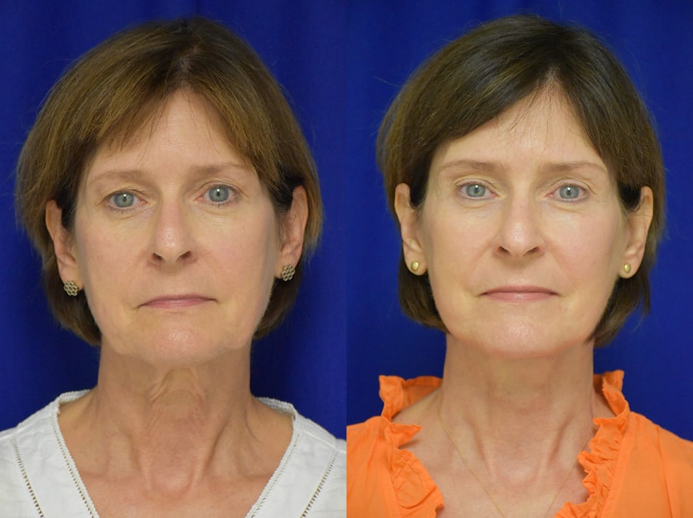 Blepharoplasty before and after photo by Dr. Sean Weiss in Metairie LA