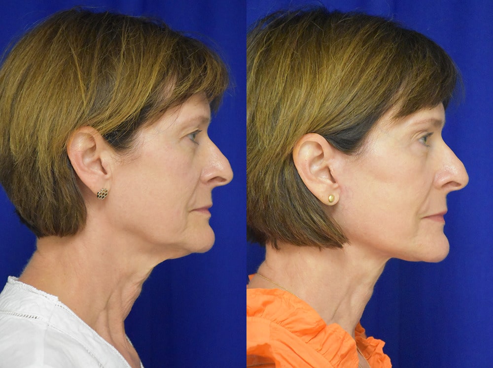 Blepharoplasty before and after photo by Dr. Sean Weiss in Metairie LA