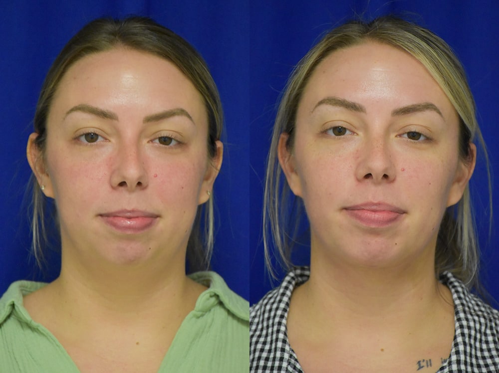Buccal fat removal before and after photo by Dr. Sean Weiss in Metairie LA