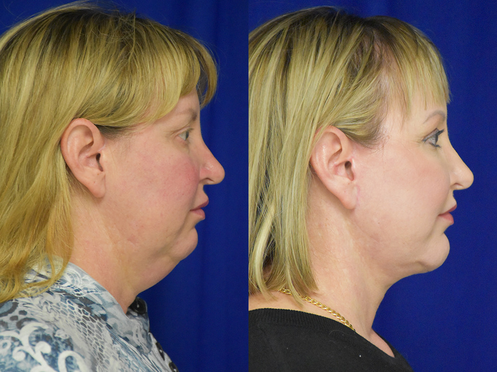 Blepharoplasty before and after photo by Dr. Sean Weiss in Metairie LA
